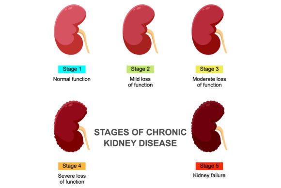 Download Stages of Chronic Kidney Disease - Disease Collection