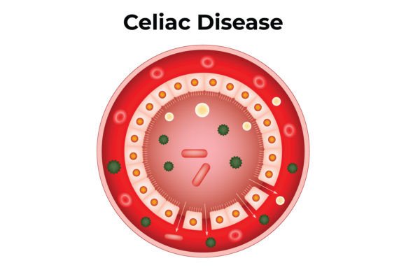 Download Celiac Disease Science Design Vector - Disease Collection