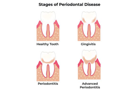 Download Stages of Periodontal Disease Science - Disease Collection